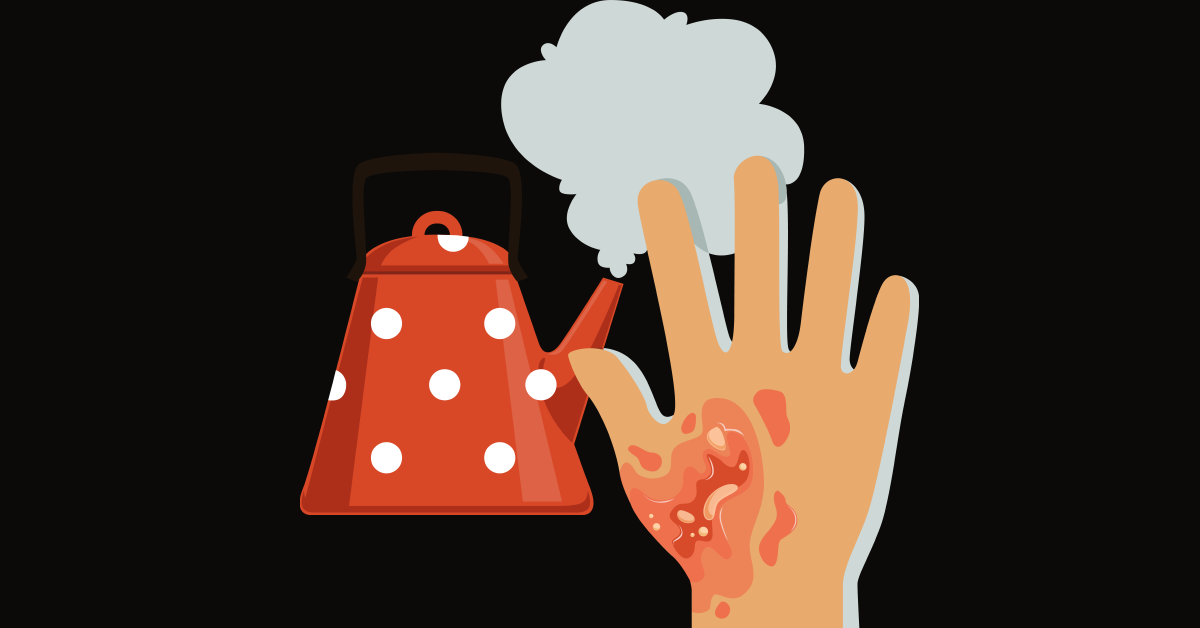 Identifying a Severe Burn