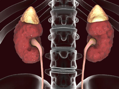 Kidney Disease