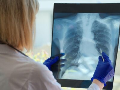 Acute Bronchitis Symptoms and Diagnosis